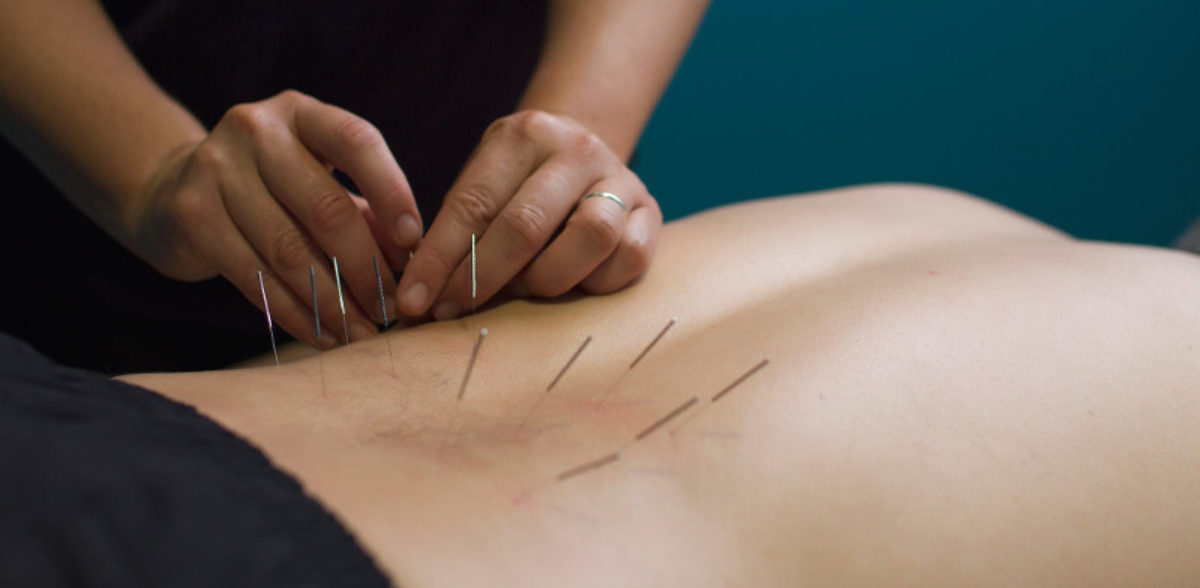 What is the difference between Dry Needling and Acupuncture?